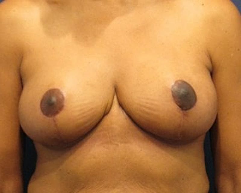 Breast Reduction Before & After