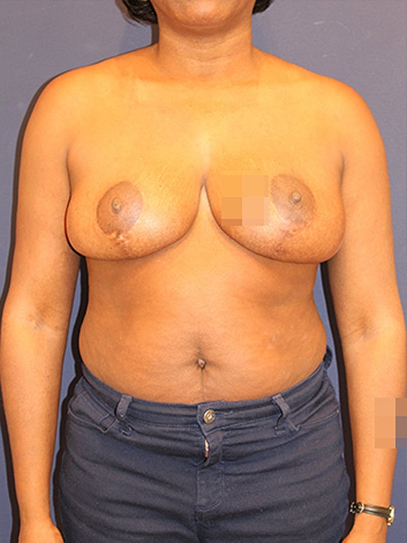 Breast Reduction Before & After