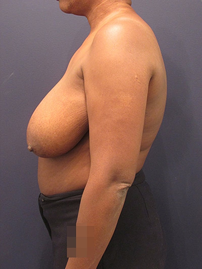 Breast Reduction Before & After