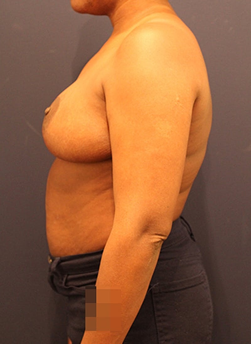 Breast Reduction Before & After