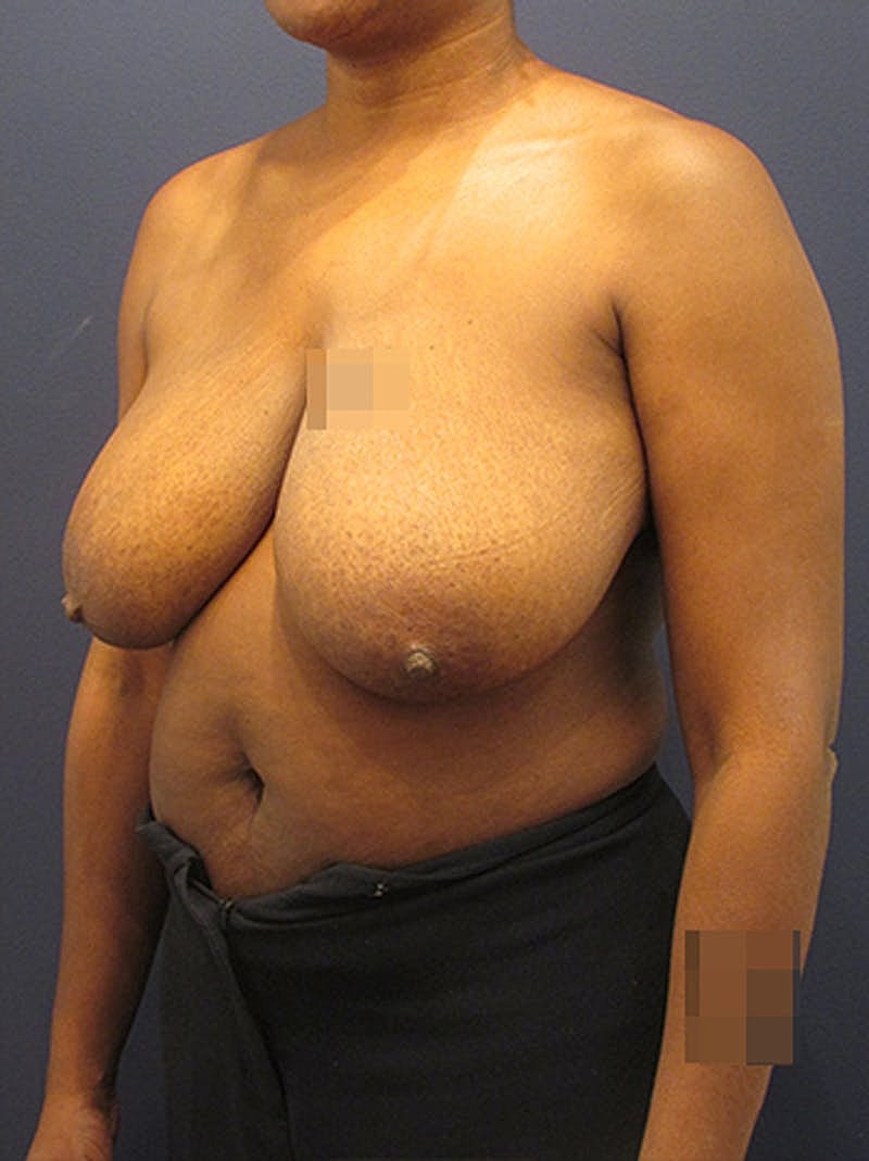 Breast Reduction Before & After
