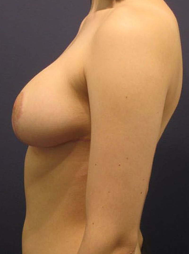 Breast Reduction Before & After