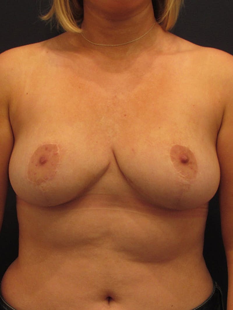 Breast Reduction Before & After