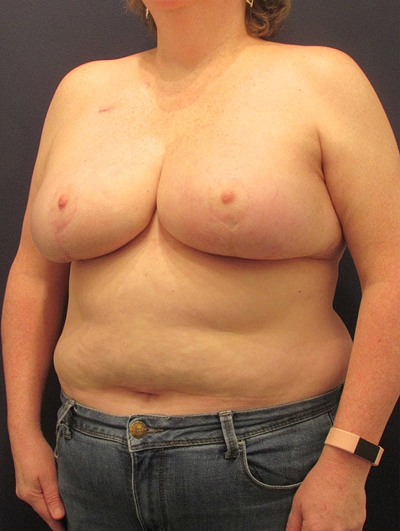 Breast Reduction Before & After