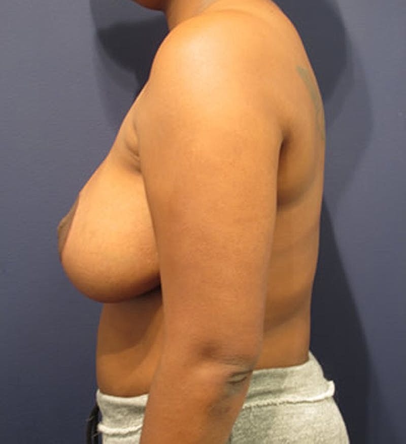Breast Reduction Before & After