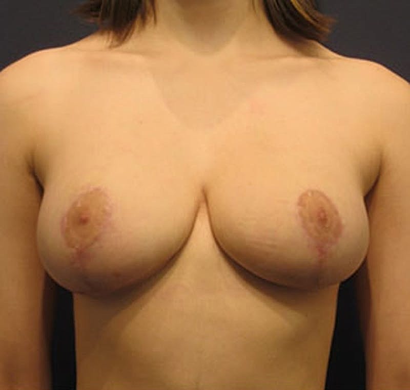 Breast Reduction Before & After