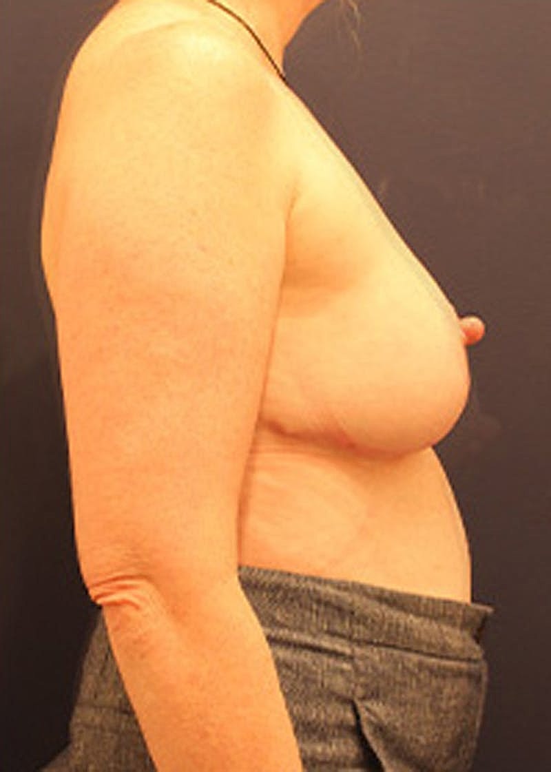 Breast Reduction Before & After