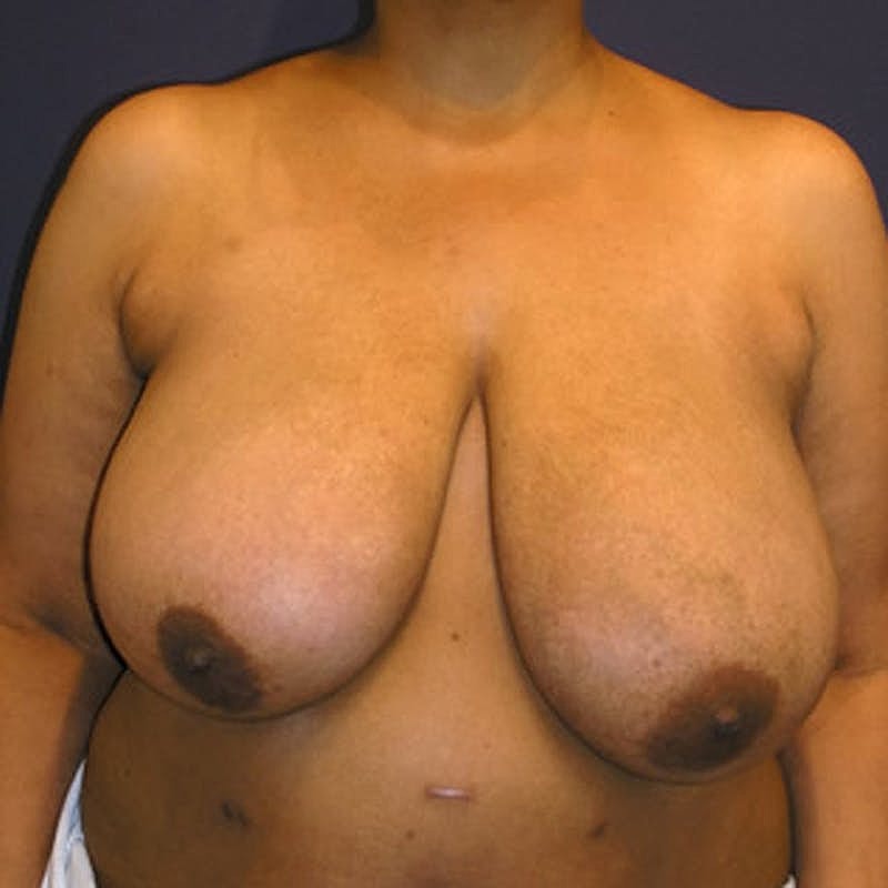 Breast Reduction Before & After
