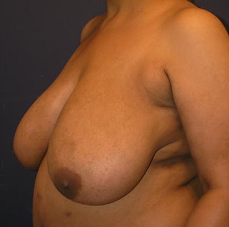 Breast Reduction Before & After