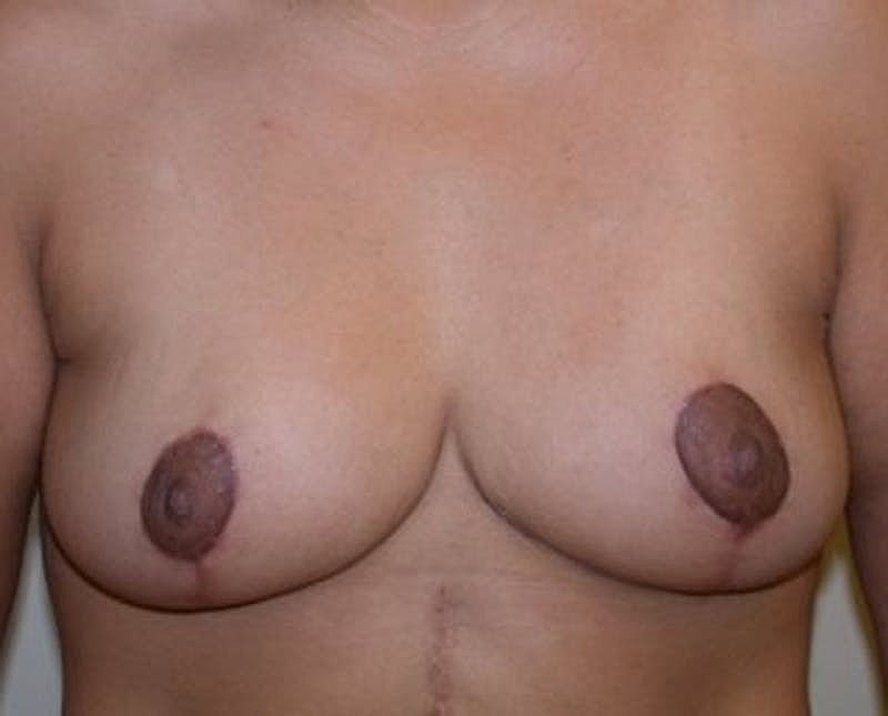 Breast Reduction Before & After
