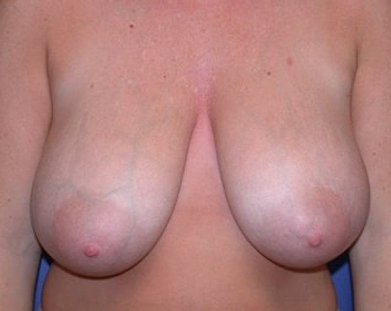 Breast Reduction Before & After