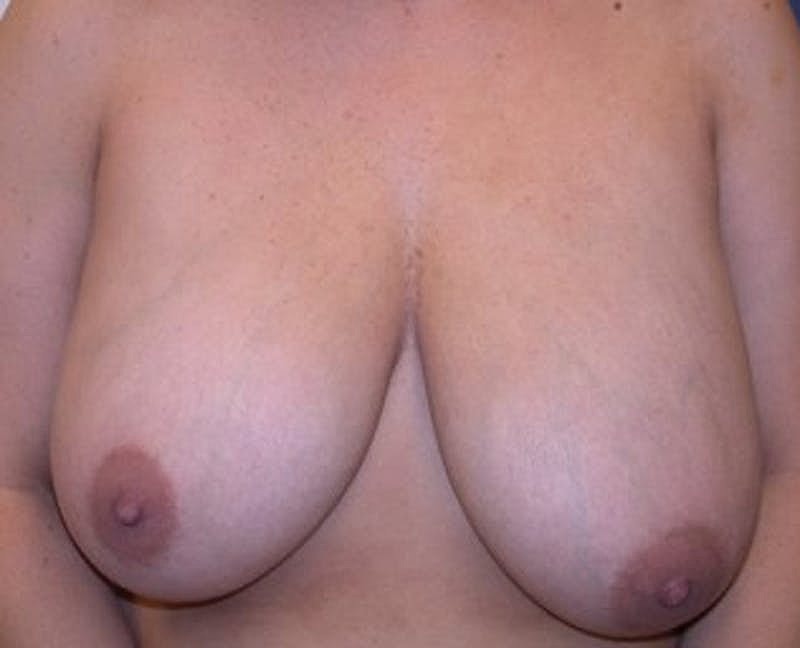 Breast Reduction Before & After