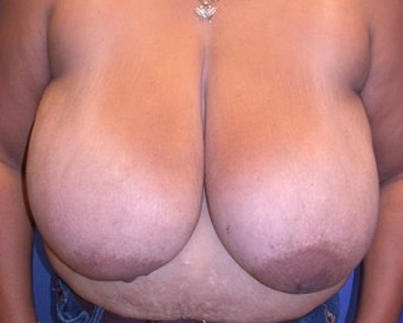 Breast Reduction Before & After