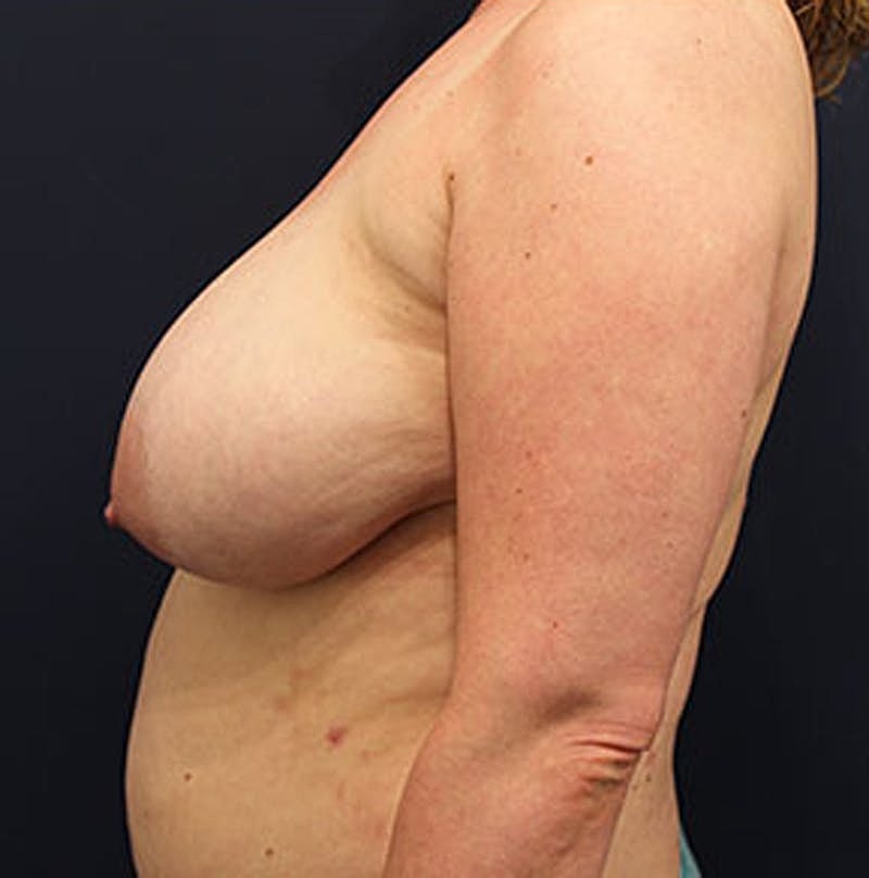Breast Reduction Before & After