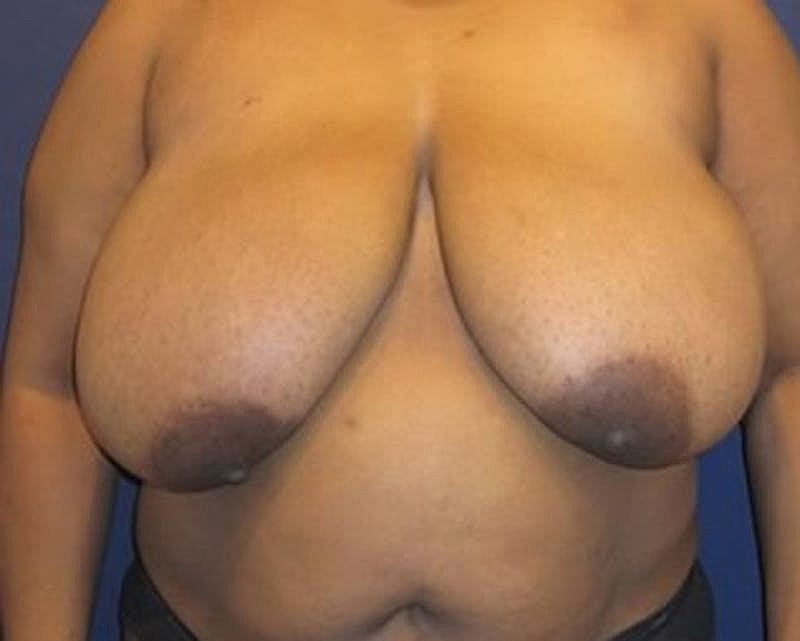 Breast Reduction Before & After