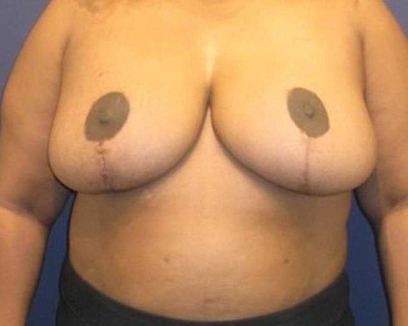 Breast Reduction Before & After