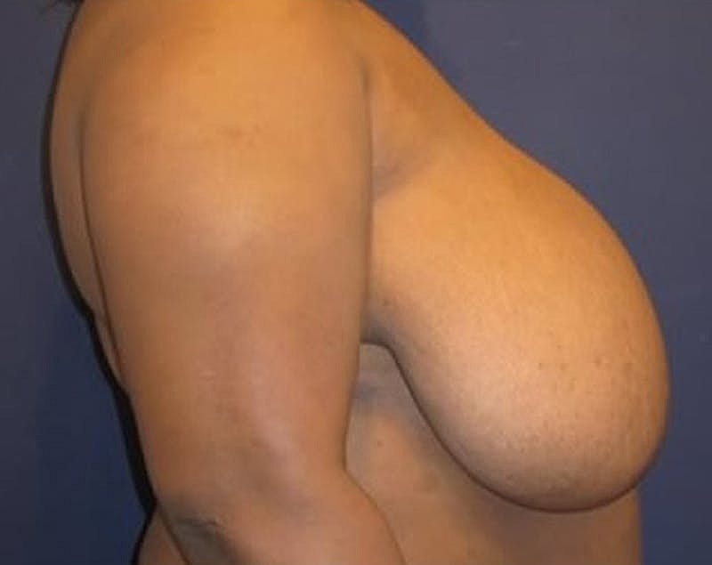 Breast Reduction Before & After
