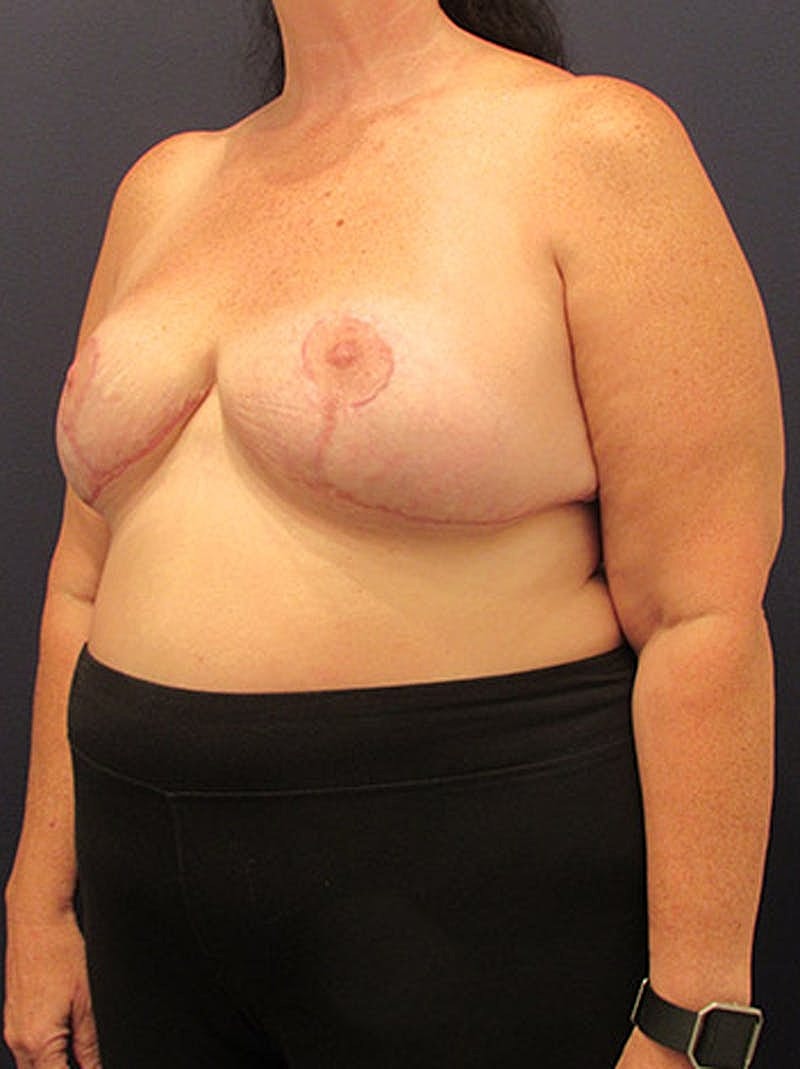 Breast Reduction Before & After