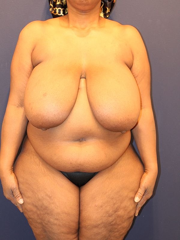 Breast Reduction Gallery Before & After