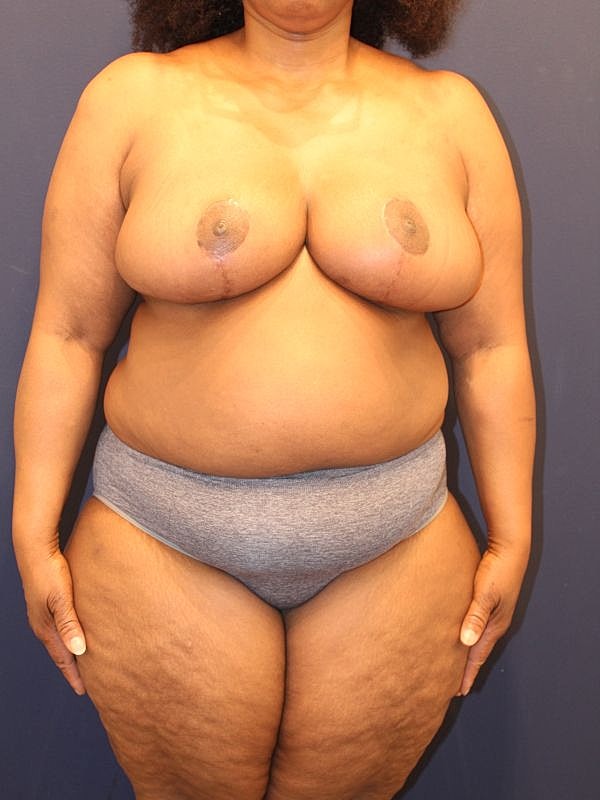 Breast Reduction Gallery Before & After