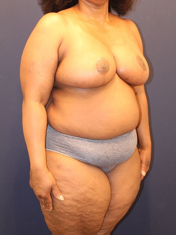 Breast Reduction Gallery Before & After