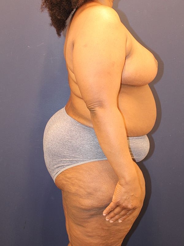 Breast Reduction Gallery Before & After