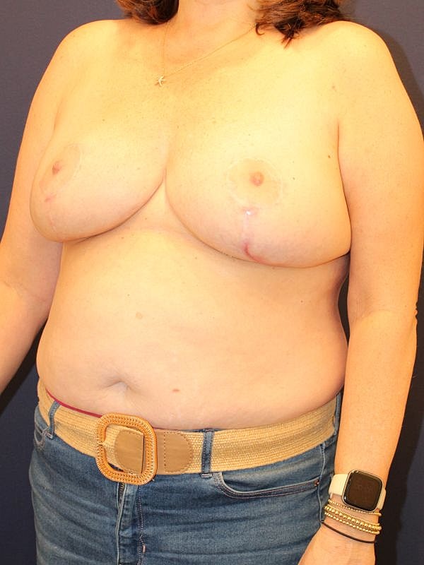 Breast Reduction Gallery Before & After