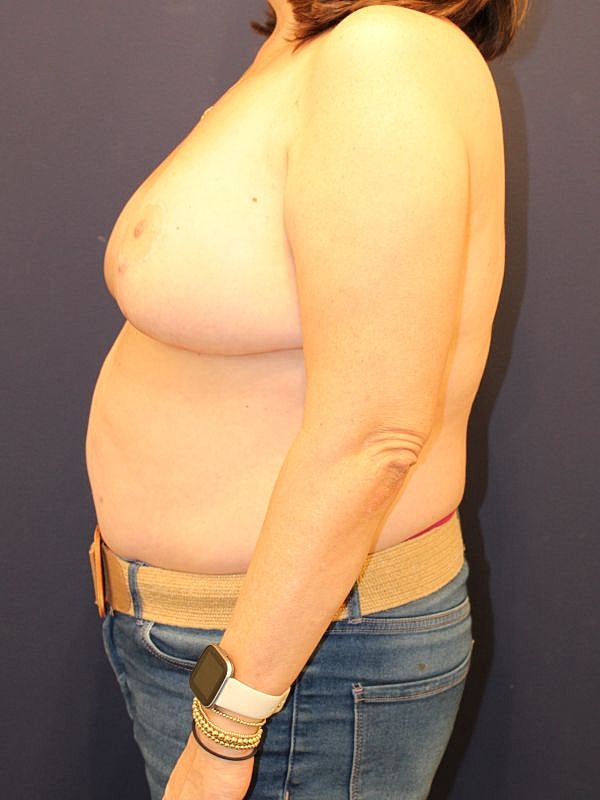 Breast Reduction Gallery Before & After