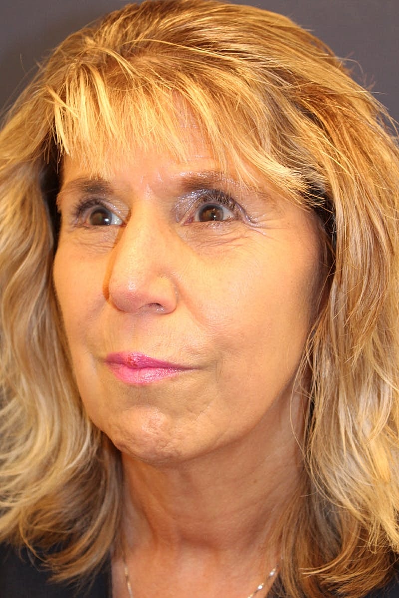 Sofwave Before & After