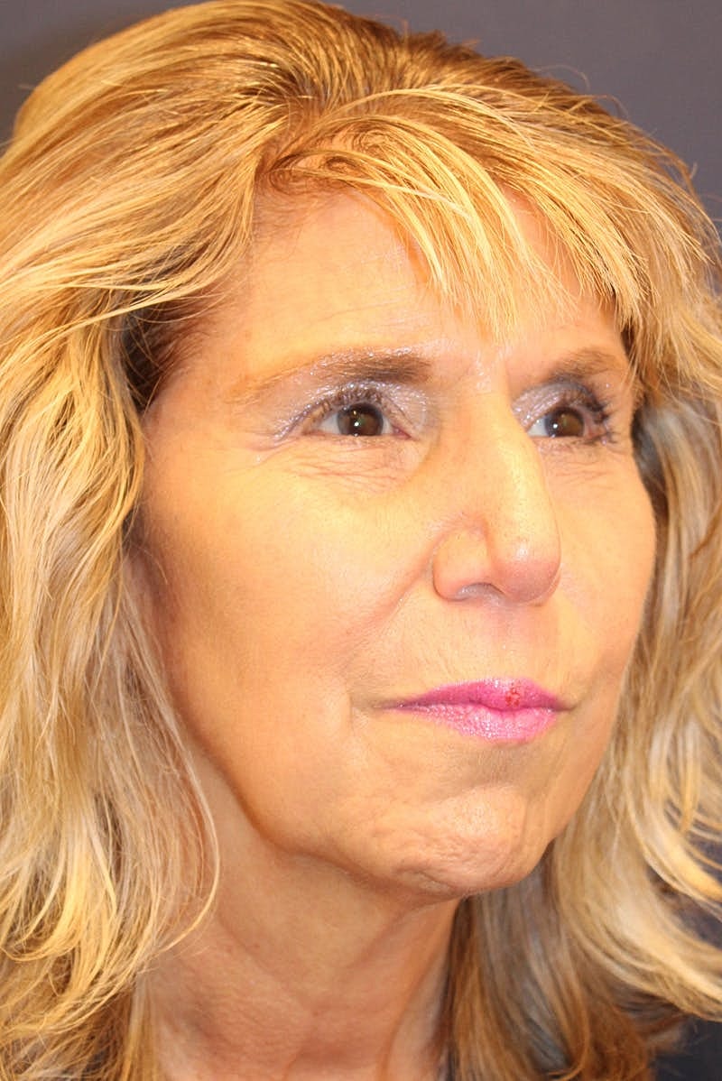 Sofwave Before & After