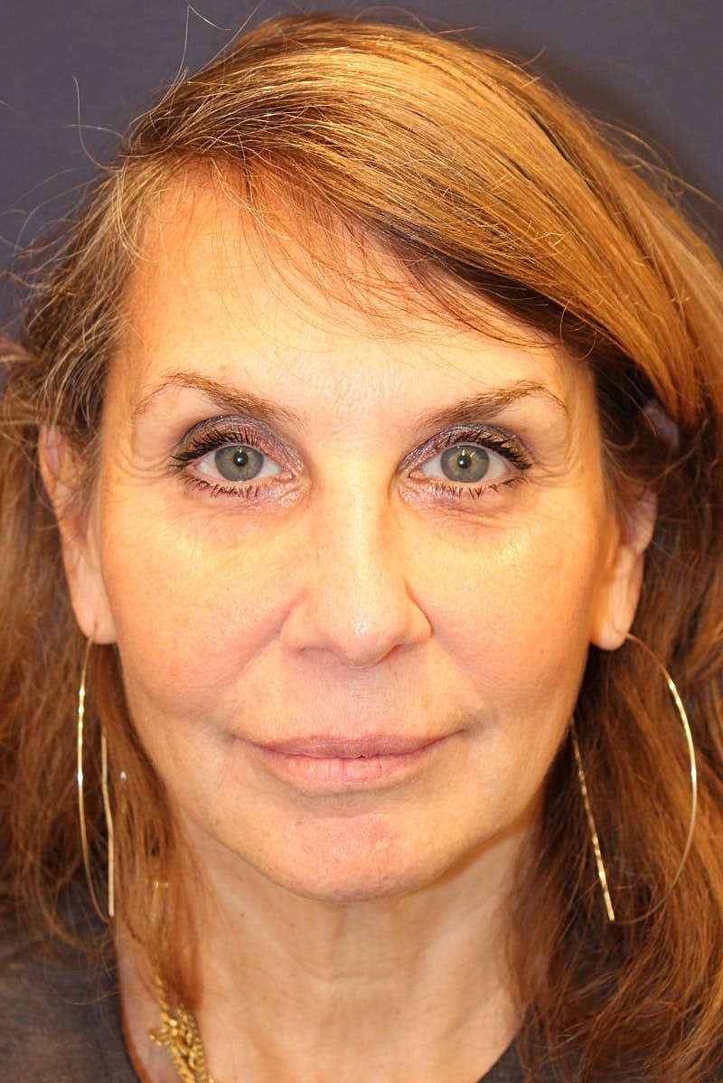 Sofwave Before & After