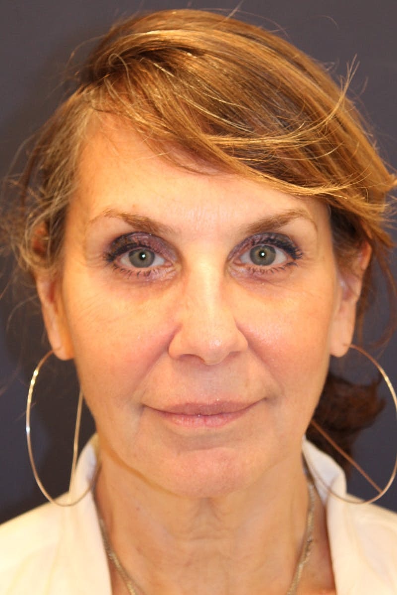 Sofwave Before & After