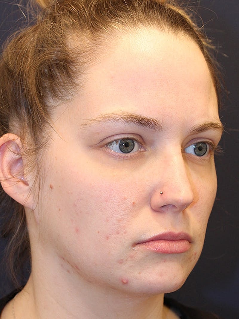 Sofwave Before & After