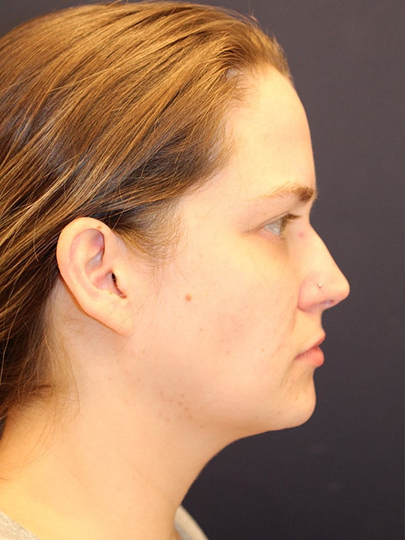 Sofwave Before & After