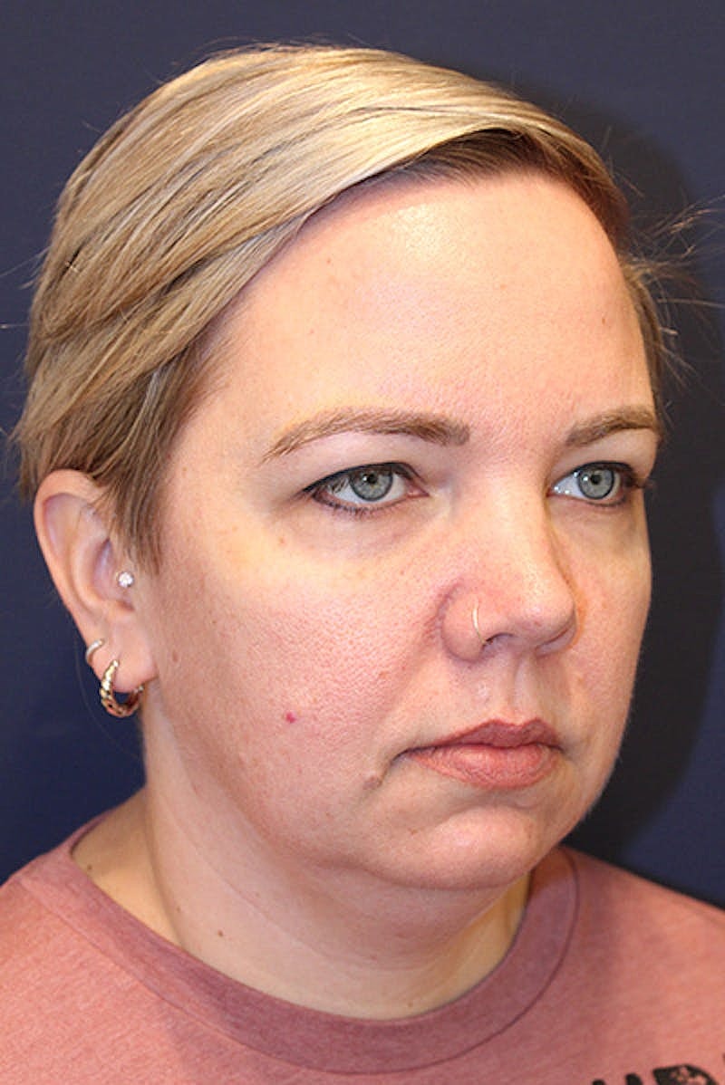 Sofwave Before & After