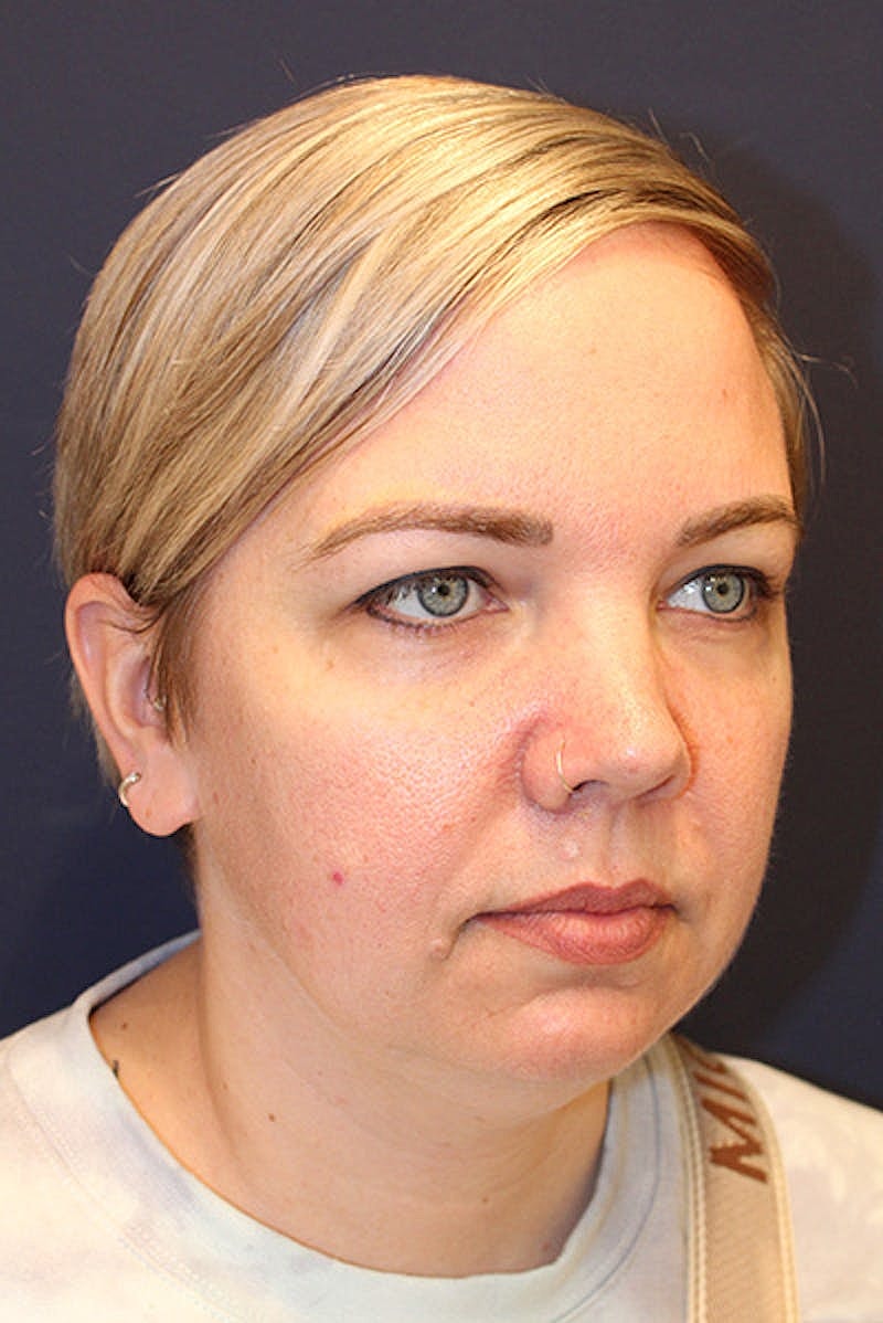 Sofwave Before & After