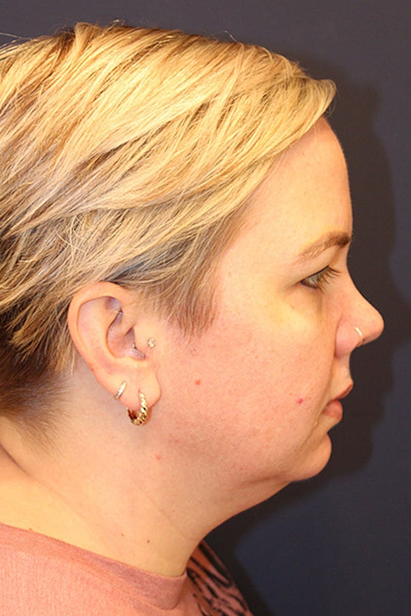 Sofwave Before & After