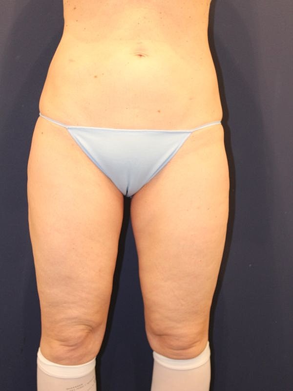 Body Lift Gallery Before & After