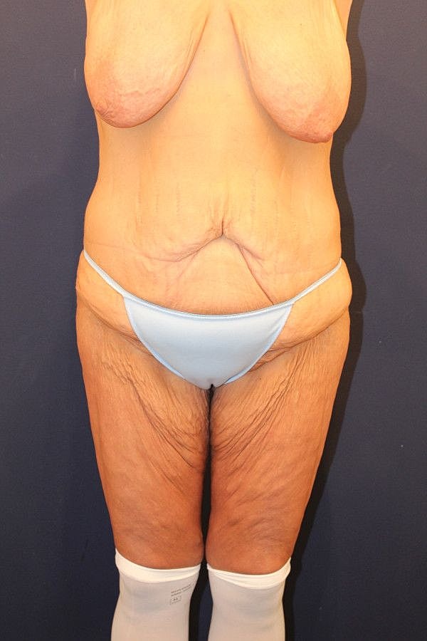 Body Lift Gallery Before & After