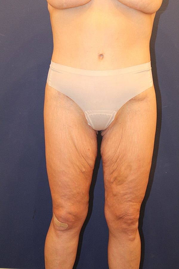 Body Lift Gallery Before & After