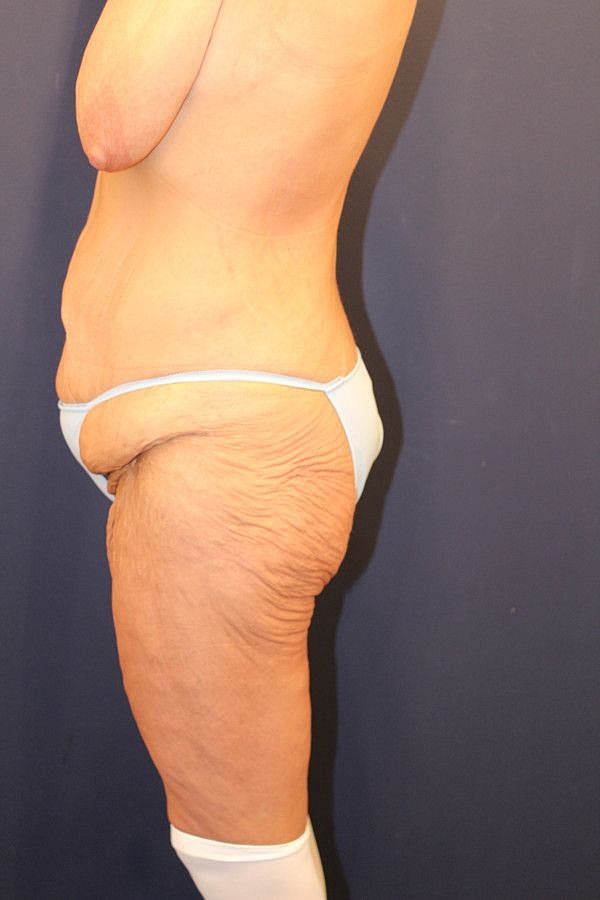 Body Lift Gallery Before & After