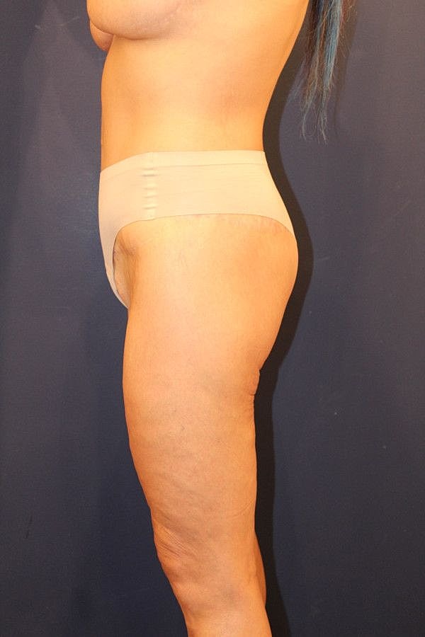 Body Lift Gallery Before & After