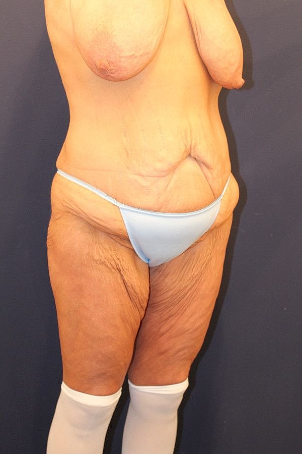 Body Lift Gallery Before & After