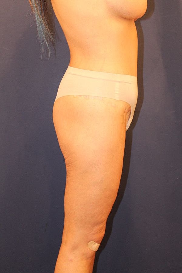 Body Lift Gallery Before & After