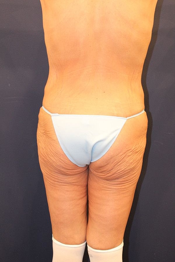 Body Lift Gallery Before & After