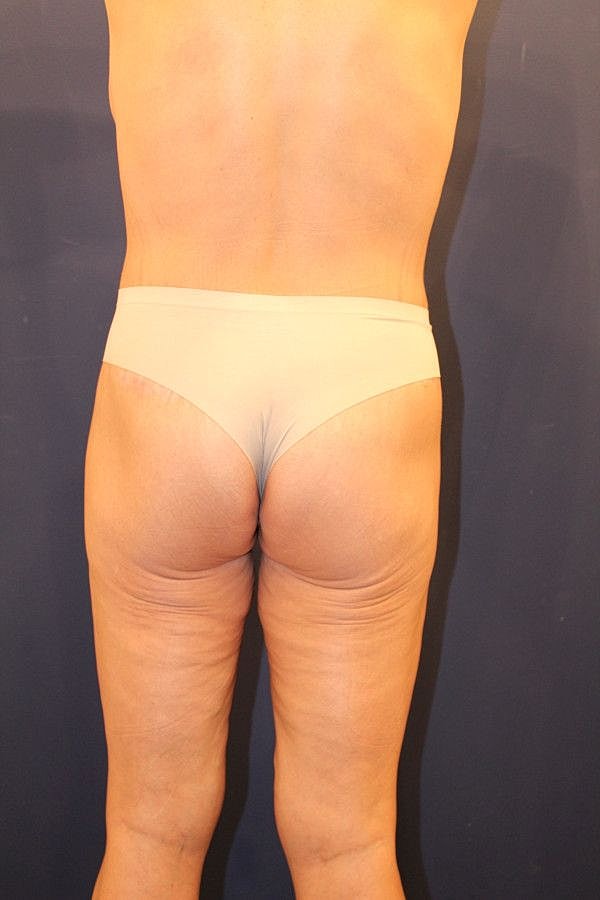 Body Lift Gallery Before & After