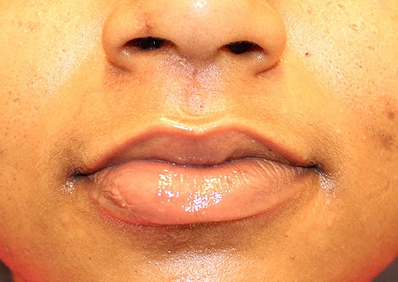 Complex Facial Reconstruction Cancer Trauma Before & After