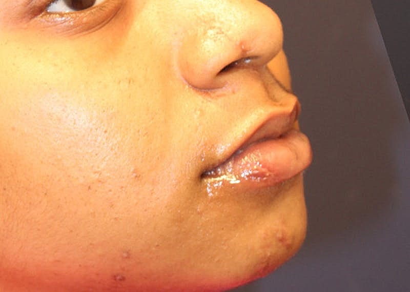 Complex Facial Reconstruction Cancer Trauma Before & After