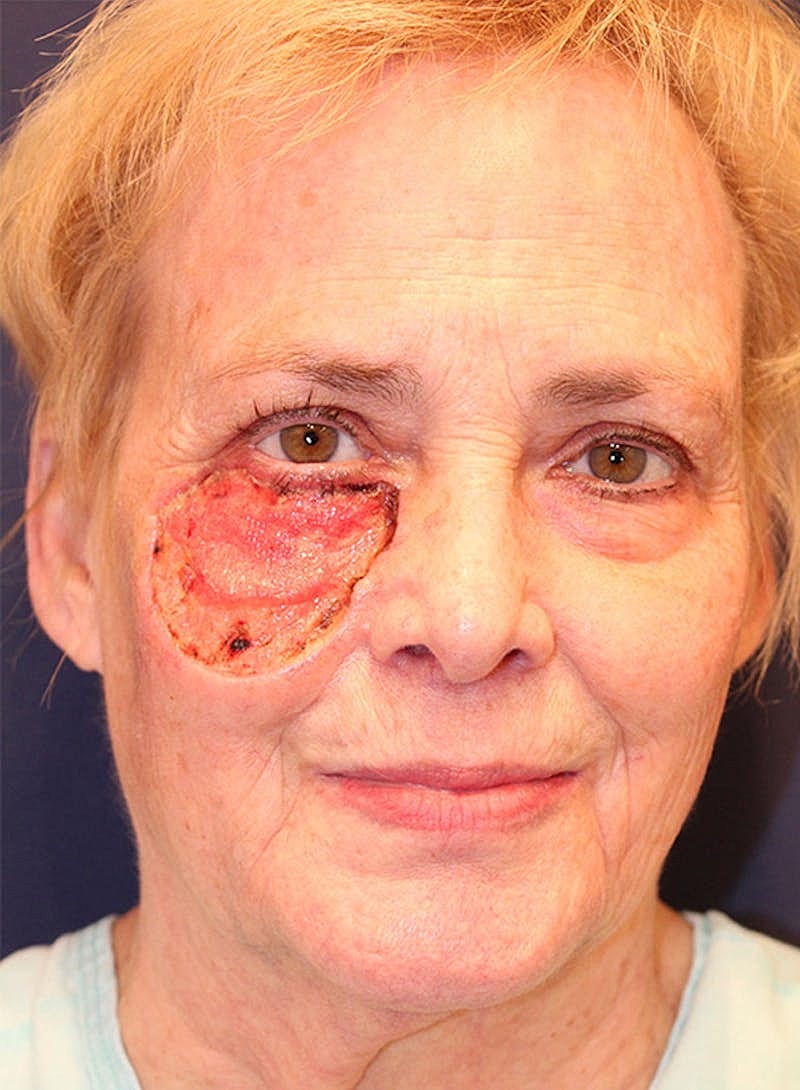 Complex Facial Reconstruction Cancer Trauma Before & After