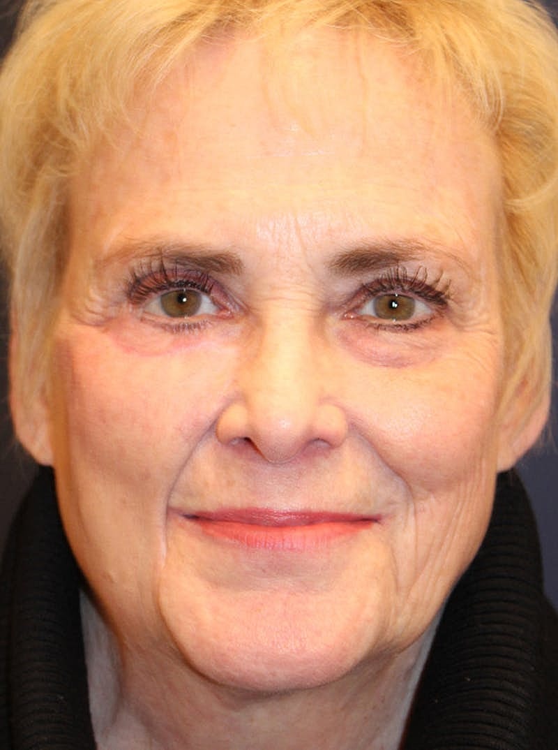 Complex Facial Reconstruction Cancer Trauma Before & After